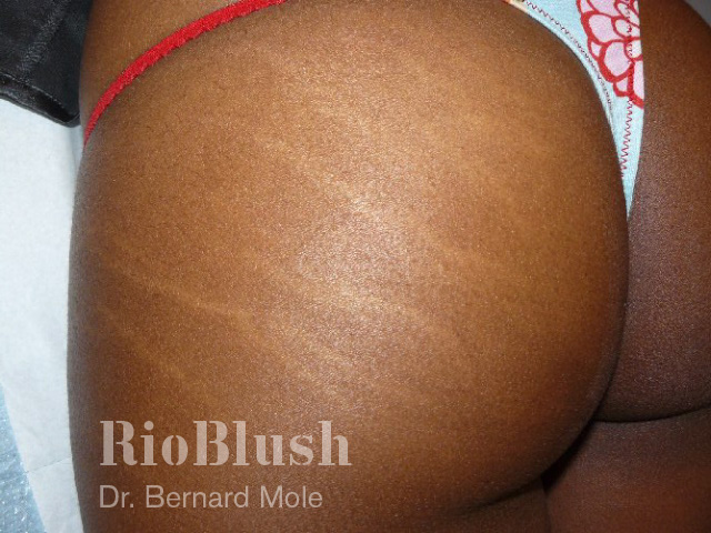 get rid of stretch marks completely 4 days,remove stretch marks from buttoc...